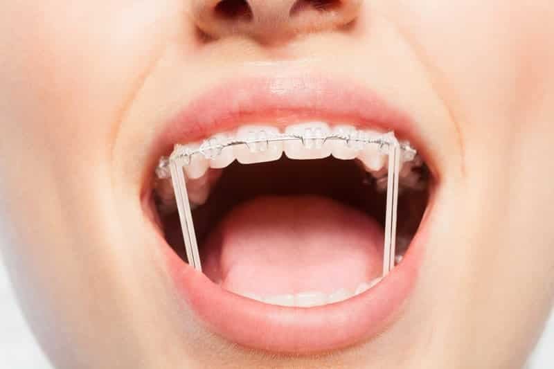 orthodonticbands