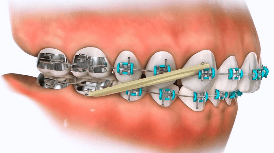 class ii elastics